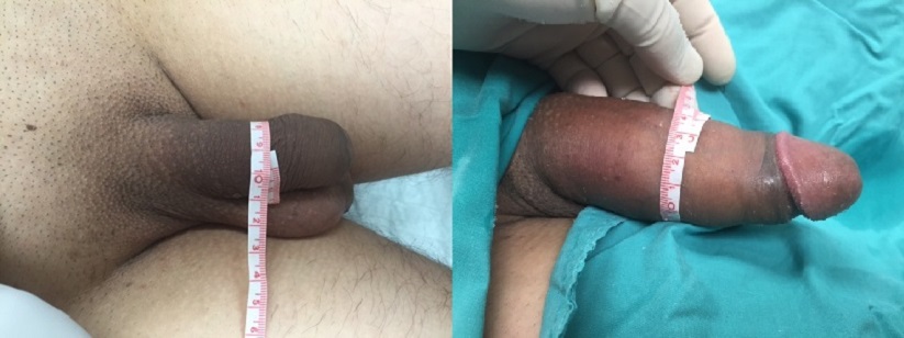 PMMA Patient 10-31-2015: PMMA Non-Surgical Girth Enhancement Before and After