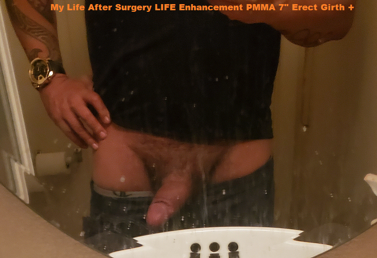 seven inches erect girth plus after Surgery Life Enhancement PMMA Injections.