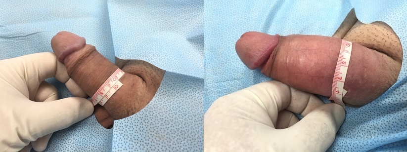 PMMA Patient 11-20-2015: PMMA Non-Surgical Girth Enhancement Before and After