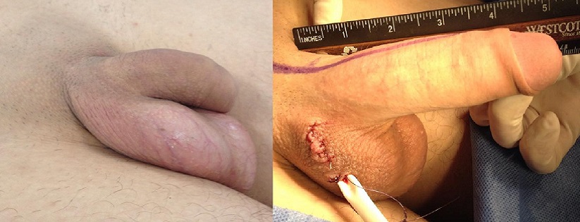 Patient underwent Penile Lengthening Surgery via Scrotal Incision