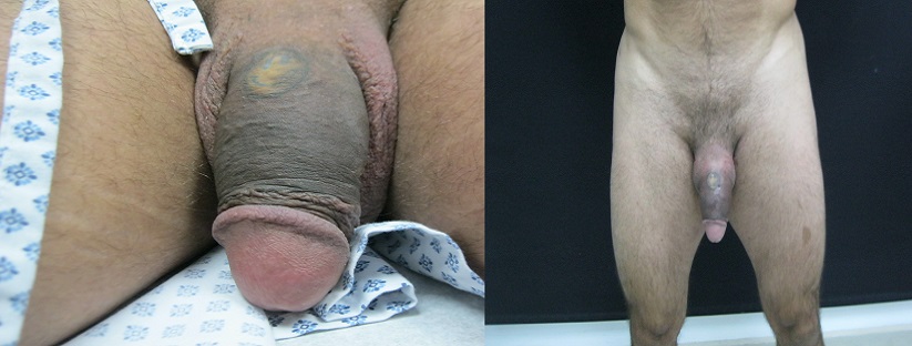 Patient had Penile Lengthening  Surgery with Traction