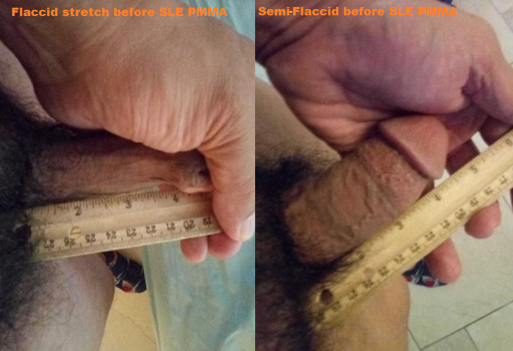 flaccid penis before Surgery Life Enhancement girth enlargement with pmma.